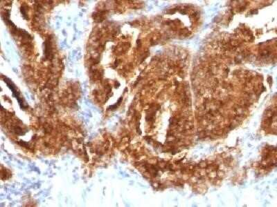 Immunohistochemistry-Paraffin: TAG-72 Antibody (CA72/733) - Azide and BSA Free [NBP2-34591] - Formalin-fixed, paraffin-embedded human prostate carcinoma stained with TAG-72 Monoclonal Antibody (CA72/733).