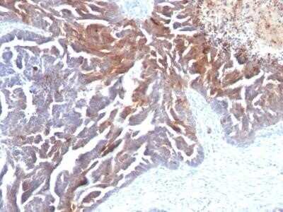 Immunohistochemistry-Paraffin: TAG-72 Antibody (CC49) - IHC-Prediluted [NBP2-45175] - Analysis using the Azide and BSA Free version of NBP2-45175. Staining of human Ovarian Carcinoma stained with TAG-72 MAb (CC49).
