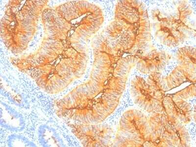 Immunohistochemistry-Paraffin: TAG-72 Antibody (SPM148) - Azide and BSA Free [NBP2-34741] - Formalin-paraffin colon cancer stained with TAG-72 MAb (SPM148). Note cytoplasmic and cell surface staining.