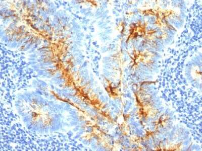 Immunohistochemistry-Paraffin: TAG-72 Antibody (SPM536) - Azide and BSA Free [NBP2-34783] - Formalin-paraffin colon cancer stained with TAG-72 MAb (SPM536). Note cytoplasmic and cell surface staining.