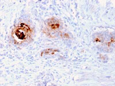 Immunohistochemistry-Paraffin: TAG-72 Antibody (rB72.3) - Azide and BSA Free [NBP3-08565] - Formalin-fixed, paraffin-embedded human Breast Carcinoma stained with TAG-72 Recombinant Mouse Monoclonal Antibody (rB72.3).