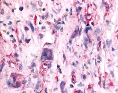 Immunohistochemistry-Paraffin: TAO Kinase 1 Antibody [NLS6871] - Analysis of anti-TAOK1 / TAO1 antibody with human brain, glioblastoma.