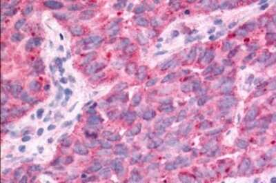 Immunohistochemistry-Paraffin: TAO Kinase 1 Antibody [NLS6871] - Anti-TAOK1 / TAO1 antibody IHC of human Lung, Non-Small Cell Carcinoma. Immunohistochemistry of formalin-fixed, paraffin-embedded tissue after heat-induced antigen retrieval.