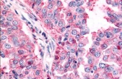 Immunohistochemistry-Paraffin: TAO Kinase 1 Antibody [NLS6871] - Anti-TAOK1 / TAO1 antibody IHC of human Lung, Non-Small Cell Carcinoma. Immunohistochemistry of formalin-fixed, paraffin-embedded tissue after heat-induced antigen retrieval.