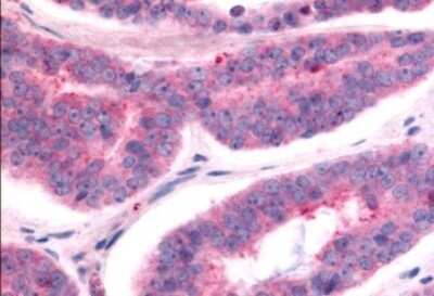 Immunohistochemistry-Paraffin: TAO Kinase 1 Antibody [NLS6871] - Anti-TAOK1 / TAO1 antibody IHC of human Prostate, Carcinoma. Immunohistochemistry of formalin-fixed, paraffin-embedded tissue after heat-induced antigen retrieval.