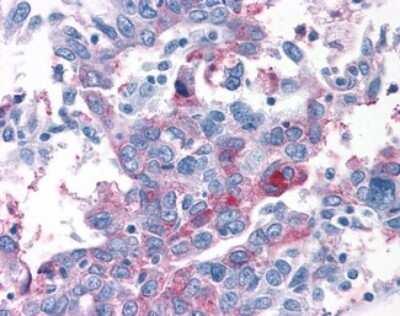 Immunohistochemistry-Paraffin: TAS1R1 Antibody [NLS1992] - Analysis of anti-T1R1 / TAS1R1 antibody with human ovary, carcinoma.