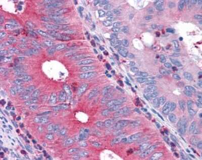 Immunohistochemistry-Paraffin: TAS1R1 Antibody [NLS1994] - Analysis of anti-T1R1 / TAS1R1 antibody with human colon, carcinoma.