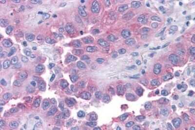 Immunohistochemistry-Paraffin: TAS1R1 Antibody [NLS1994] - Anti-T1R1 / TAS1R1 antibody IHC of human Lung, Non-Small Cell Carcinoma. Immunohistochemistry of formalin-fixed, paraffin-embedded tissue after heat-induced antigen retrieval.