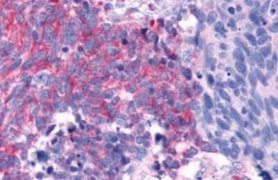 Immunohistochemistry-Paraffin: TAS1R2 Antibody [NLS2007] - Anti-TAS1R2 / T1R2 antibody IHC of human Lung, Small Cell Carcinoma. Immunohistochemistry of formalin-fixed, paraffin-embedded tissue after heat-induced antigen retrieval.