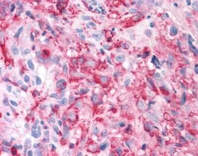 Immunohistochemistry-Paraffin: TAS1R3 Antibody [NLS5073] - Analysis of anti-T1R3 / TAS1R3 antibody with human brain, glioblastoma.
