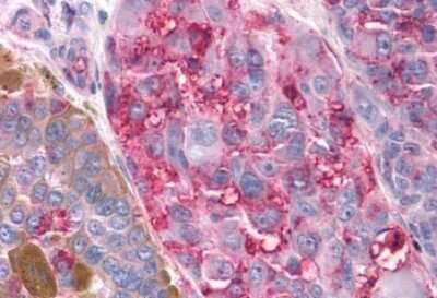 Immunohistochemistry-Paraffin: TAS1R3 Antibody [NLS5073] - Anti-T1R3 / TAS1R3 antibody IHC of human Skin, Melanoma. Immunohistochemistry of formalin-fixed, paraffin-embedded tissue after heat-induced antigen retrieval.