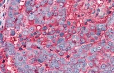 Immunohistochemistry-Paraffin: TAS1R3 Antibody [NLS5073] - Anti-T1R3 / TAS1R3 antibody IHC of human Ovary, Carcinoma. Immunohistochemistry of formalin-fixed, paraffin-embedded tissue after heat-induced antigen retrieval.