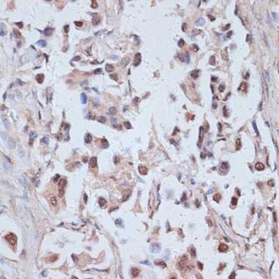 Immunohistochemistry-Paraffin: TAX1BP1 Antibody [NBP3-05150] - Paraffin-embedded human lung cancer using TAx1BP1 antibody at dilution of 1:100 (40x lens).