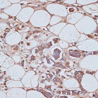 Immunohistochemistry-Paraffin: TAX1BP1 Antibody [NBP3-05150] - Paraffin-embedded human breast cancer using TAx1BP1 antibody at dilution of 1:100 (40x lens).