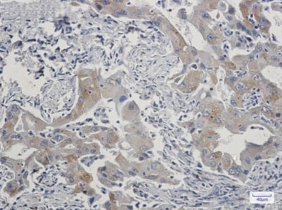 Immunohistochemistry-Paraffin: TAX1BP1 Antibody (S07-6F6) [NBP3-19794] - Immunohistochemistry of TAX1BP1 in paraffin-embedded Human lung cancer tissue using NBP3-19794 at dilution 1/20