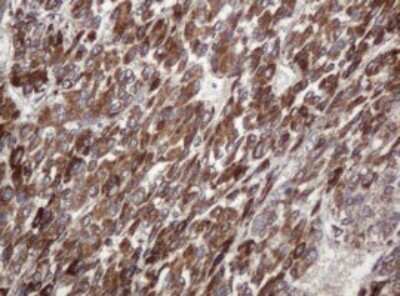 Immunohistochemistry: TBC1D13 Antibody (OTI2C5) - Azide and BSA Free [NBP2-74450] - Analysis of Carcinoma of Human liver tissue.(Heat-induced epitope retrieval by 10mM citric buffer, pH6.0, 120C for 3min)