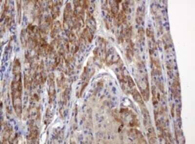 Immunohistochemistry: TBC1D13 Antibody (OTI2C5) - Azide and BSA Free [NBP2-74450] - Analysis of Carcinoma of Human thyroid tissue. (Heat-induced epitope retrieval by 10mM citric buffer, pH6.0, 120C for 3min)