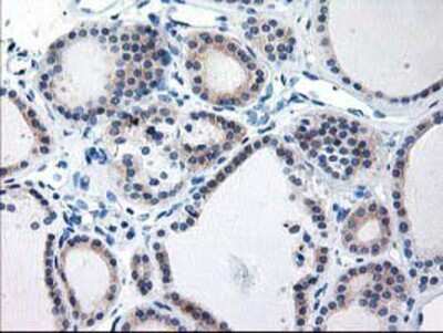 Immunohistochemistry-Paraffin: TBC1D21 Antibody (2A6) [NBP2-01311] - Staining of paraffin-embedded Carcinoma of Human thyroid tissue using anti-TBC1D21 mouse monoclonal antibody.