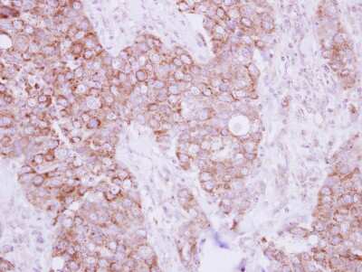 Immunohistochemistry-Paraffin: TBRG4 Antibody [NBP2-20582] - Immunohistochemical analysis of paraffin-embedded Breast ca, using antibody at 1:250 dilution.