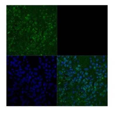 Immunohistochemistry: TBX3 Antibody [NBP3-10971] - Immunohistochemical analysis of primary metastatic melanoma