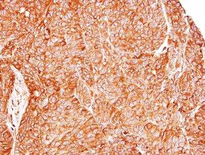 Immunohistochemistry-Paraffin: TC21/R-Ras2 Antibody [NBP1-32919] - Paraffin-embedded DLD1 xenograft, using antibody at 1:500 dilution.