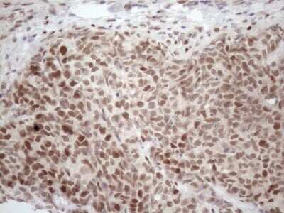 Immunohistochemistry: TCEAL1 Antibody (OTI2G10) - Azide and BSA Free [NBP2-74472] - Analysis of Adenocarcinoma of Human endometrium tissue. (Heat-induced epitope retrieval by 1mM EDTA in 10mM Tris buffer (pH8.5) at 120C for 3 min)