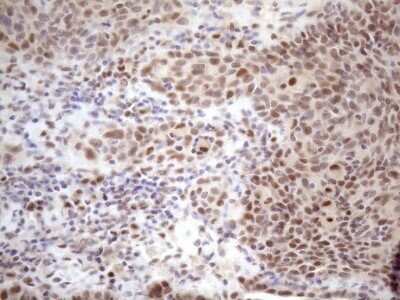 Immunohistochemistry: TCEAL1 Antibody (OTI2G10) - Azide and BSA Free [NBP2-74472] - Analysis of Carcinoma of Human bladder tissue. (Heat-induced epitope retrieval by 1mM EDTA in 10mM Tris buffer (pH8.5) at 120C for 3 min)