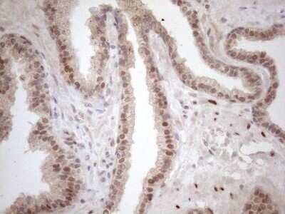 Immunohistochemistry: TCEAL1 Antibody (OTI2G10) - Azide and BSA Free [NBP2-74472] - Analysis of Carcinoma of Human prostate tissue. (Heat-induced epitope retrieval by 1mM EDTA in 10mM Tris buffer (pH8.5) at 120C for 3 min)