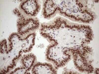 Immunohistochemistry: TCEAL1 Antibody (OTI2G10) - Azide and BSA Free [NBP2-74472] - Analysis of Carcinoma of Human thyroid tissue. (Heat-induced epitope retrieval by 1mM EDTA in 10mM Tris buffer (pH8.5) at 120C for 3 min)