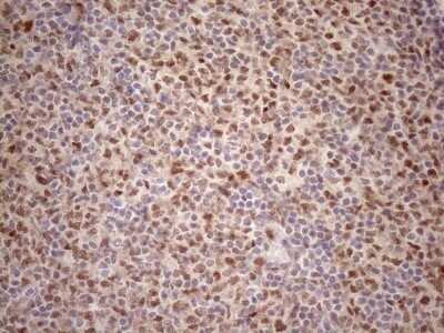 Immunohistochemistry: TCEAL1 Antibody (OTI2G10) - Azide and BSA Free [NBP2-74472] - Analysis of Human lymphoma tissue. (Heat-induced epitope retrieval by 1mM EDTA in 10mM Tris buffer (pH8.5) at 120C for 3 min)(