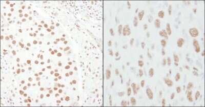 <b>Biological Strategies Validation. </b>Immunohistochemistry-Paraffin: TCERG1 Antibody [NB300-214] - Section of human breast carcinoma (left) and mouse squamous cellcarcinoma (right). Antibody: Affinity purified rabbit anti-CA150  used at a dilution of 1:1,000 (1ug/ml). Detection: DAB