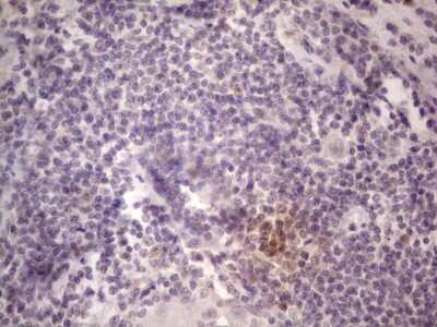 Immunohistochemistry: TCF-12/HTF4 Antibody (4D6) [NBP2-46086] - Analysis of Carcinoma of Human lung tissue.(Heat-induced epitope retrieval by 1 mM EDTA in 10mM Tris, pH8.5, 120C for 3min)