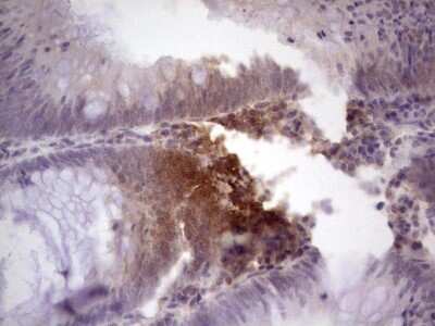 Immunohistochemistry: TCF-12/HTF4 Antibody (OTI4D6) - Azide and BSA Free [NBP2-74473] - Analysis of Adenocarcinoma of Human colon tissue. (Heat-induced epitope retrieval by 1 mM EDTA in 10mM Tris, pH8.5, 120C for 3min)