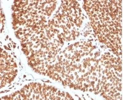 Immunohistochemistry-Paraffin: TCF4 Antibody (TCF4/2252) [NBP3-13789] - Formalin-fixed, paraffin-embedded human bladder carcinoma stained with TCF4 antibody (TCF4/2252) at 2ug/ml. HIER: Tris/EDTA, pH9.0, 45min. HRP-polymer, 30min. DAB, 5min.