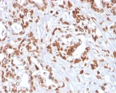 Immunohistochemistry-Paraffin: TCF4 Antibody (TCF4/2252) [NBP3-13789] - Formalin-fixed, paraffin-embedded human breast carcinoma stained with TCF4 antibody (TCF4/2252) at 2ug/ml. HIER: Tris/EDTA, pH9.0, 45min. HRP-polymer, 30min. DAB, 5min.