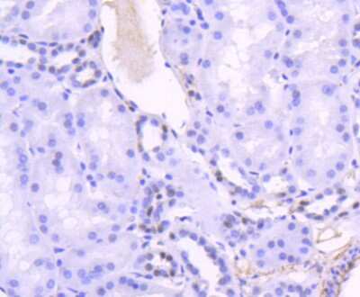 Immunohistochemistry-Paraffin: TCF7L2 Antibody (SC06-90) [NBP2-67618] - Analysis of paraffin-embedded human breast carcinoma tissue using anti-TCF7L2 antibody. Counter stained with hematoxylin.