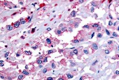 Immunohistochemistry-Paraffin: TDAG8/GPR65 Antibody [NLS1625] - Pancreas, carcinoma