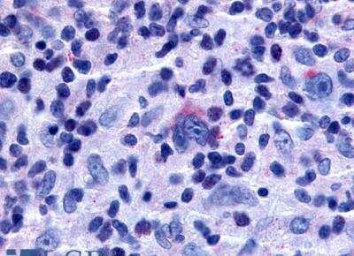 Immunohistochemistry-Paraffin: TDAG8/GPR65 Antibody [NLS1627] - Human Lymph Node, Hodgkins Lymphoma tissue after heat-induced antigen retrieval.