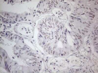 Immunohistochemistry: TDG Antibody (OTI3C11) - Azide and BSA Free [NBP2-74484] - Analysis of Adenocarcinoma of Human colon tissue. (Heat-induced epitope retrieval by 1mM EDTA in 10mM Tris buffer (pH8.5) at 120C for 3 min)