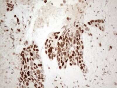 Immunohistochemistry: TDG Antibody (OTI3C11) - Azide and BSA Free [NBP2-74484] - Analysis of Adenocarcinoma of Human endometrium tissue. (Heat-induced epitope retrieval by 1mM EDTA in 10mM Tris buffer (pH8.5) at 120C for 3 min)