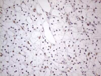 Immunohistochemistry: TDG Antibody (OTI3C11) - Azide and BSA Free [NBP2-74484] - Analysis of Carcinoma of Human kidney tissue. (Heat-induced epitope retrieval by 1mM EDTA in 10mM Tris buffer (pH8.5) at 120C for 3 min)