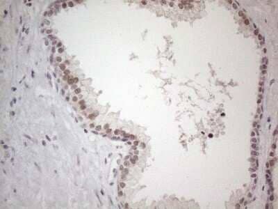 Immunohistochemistry: TDG Antibody (OTI3C11) - Azide and BSA Free [NBP2-74484] - Analysis of Carcinoma of Human prostate tissue. (Heat-induced epitope retrieval by 1mM EDTA in 10mM Tris buffer (pH8.5) at 120C for 3 min)