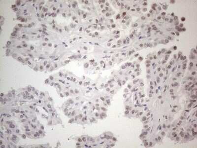 Immunohistochemistry: TDG Antibody (OTI3C11) - Azide and BSA Free [NBP2-74484] - Analysis of Carcinoma of Human thyroid tissue. (Heat-induced epitope retrieval by 1mM EDTA in 10mM Tris buffer (pH8.5) at 120C for 3 min)