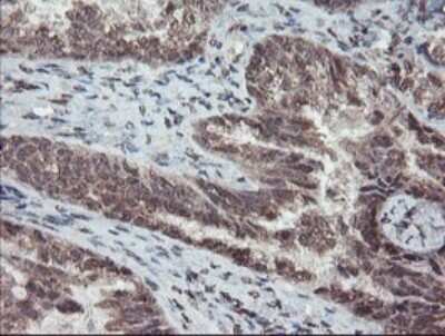 Immunohistochemistry-Paraffin: TDO2 Antibody (OTI2A4) [NBP2-45995] -  Staining of paraffin-embedded Adenocarcinoma of Human ovary tissue using anti-TDO2 mouse monoclonal antibody. (Heat-induced epitope retrieval by 10mM citric buffer, pH6.0, 100C for 10min.,