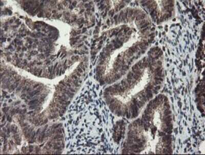 Immunohistochemistry-Paraffin: TDO2 Antibody (OTI2A4) [NBP2-45995] -  Staining of paraffin-embedded Adenocarcinoma of Human endometrium tissue using anti-TDO2 mouse monoclonal antibody. (Heat-induced epitope retrieval by 10mM citric buffer, pH6.0, 100C for 10min. 