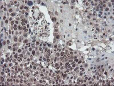 Immunohistochemistry: TDO2 Antibody (OTI2A4) - Azide and BSA Free [NBP2-74486] - Staining of paraffin-embedded Carcinoma of Human lung tissue using anti-TDO2 mouse monoclonal antibody. (Heat-induced epitope retrieval by 10mM citric buffer, pH6.0, 100C for 10min.