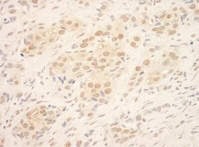Immunohistochemistry-Paraffin: TDRD3 Antibody [NBP1-46821] - Section of human breast carcinoma. Antibody: Affinity purified rabbit anti- TDRD3 used at a dilution of 1:1,000 (1ug/ml). Detection: DAB