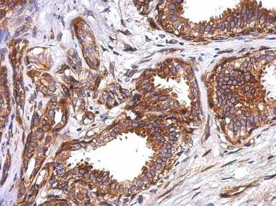 Immunohistochemistry-Paraffin: TEKT5 Antibody [NBP2-20595] - Immunohistochemical analysis of paraffin-embedded Breast ca, using antibody at 1:200 dilution.