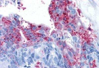 Immunohistochemistry-Paraffin: TEM5/GPR124 Antibody [NBP1-02342] - Staining of human colon carcinoma. Immunohistochemistry of formalin-fixed, paraffin-embedded tissue after heat-induced antigen retrieval. Antibody concentration 11 ug/ml.