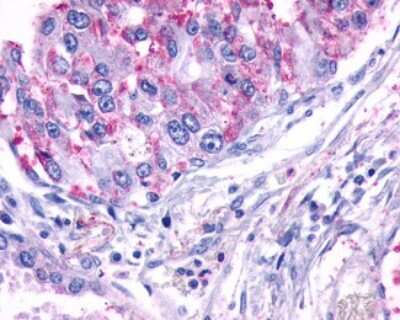 Immunohistochemistry-Paraffin: TEM5/GPR124 Antibody [NLS2167] - Analysis of anti-GPR124 / TEM5 antibody with human lung, adenocarcinoma.